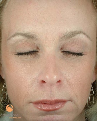 Female Patient Treated with BOTOX® Cosmetic after 1047033