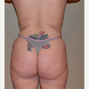 25-34 year old woman treated with Brazilian Butt Lift Revision before 1975684