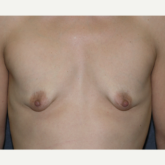 35-44 year old woman treated with Breast Augmentation before 3454858