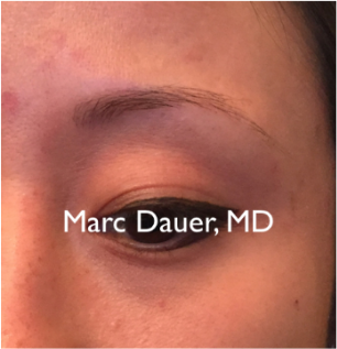 25-34 year old woman treated with Eyebrow Transplant 3377665