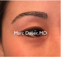25-34 year old woman treated with Eyebrow Transplant after 3377665