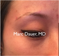 25-34 year old woman treated with Eyebrow Transplant before 3377665