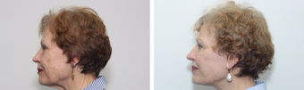 65-74 year old woman treated with Facelift after 3742226