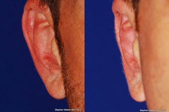 Ear Surgery before 1445746