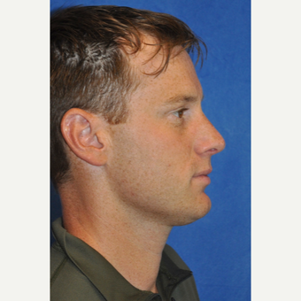 Male Rhinoplasty after 3248106