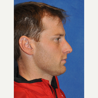 Male Rhinoplasty before 3248106