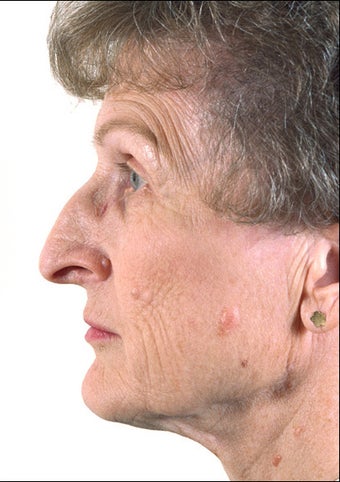 Rhinoplasty on Mature Adult before 1023354