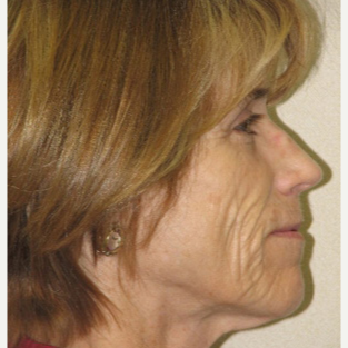 45-54 year old woman treated with Injectable Fillers before 3137164