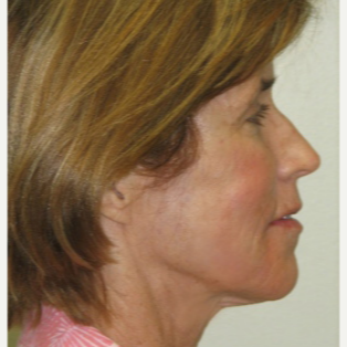 45-54 year old woman treated with Injectable Fillers after 3137164