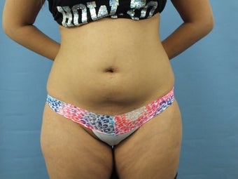 Liposuction before 1024388