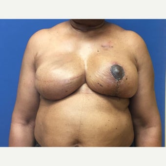 55-64 year old woman treated with Breast Reconstruction after 1818384