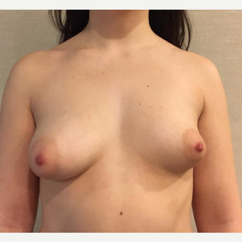 25-34 year old woman treated with Breast Fat Transfer before 3738015