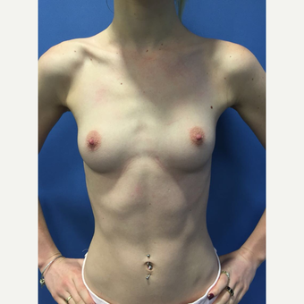 18-24 year old woman treated with Breast Augmentation before 3415477