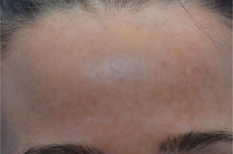 Facial after 3496475