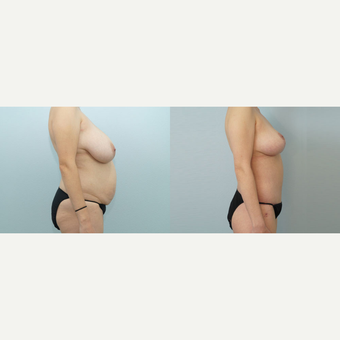 38 yr old Female - Mommy Makeover after 3099978