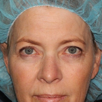 59 year old woman treated with Laser Resurfacing using multiple lasers in one treatment session before 1644193