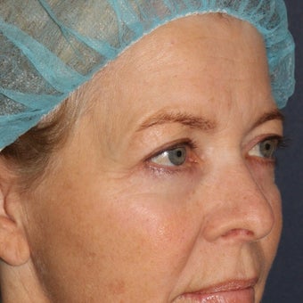 59 year old woman treated with Laser Resurfacing using multiple lasers in one treatment session 1644193