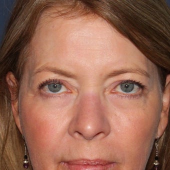 59 year old woman treated with Laser Resurfacing using multiple lasers in one treatment session after 1644193