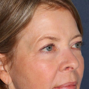 59 year old woman treated with Laser Resurfacing using multiple lasers in one treatment session 1644193