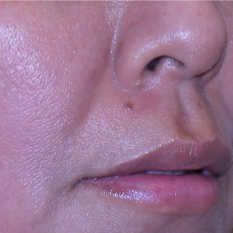 35 year old woman treated with Mole Removal from upper lip after 2687961