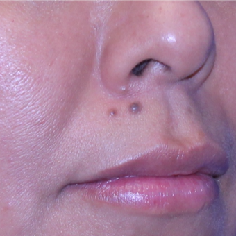 35 year old woman treated with Mole Removal from upper lip before 2687961