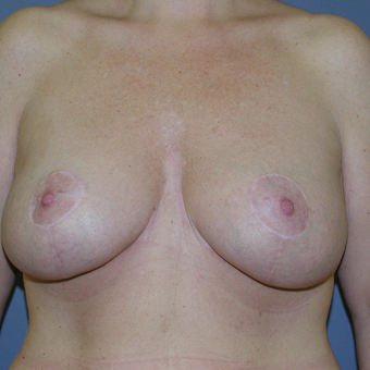 41 year old woman treated with Breast Lift after 3042790