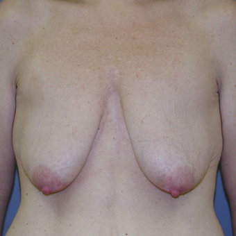41 year old woman treated with Breast Lift before 3042790