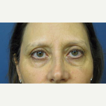 45-54 year old woman treated with Eyelid Surgery before 3383991