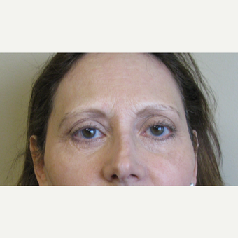 45-54 year old woman treated with Eyelid Surgery after 3383991