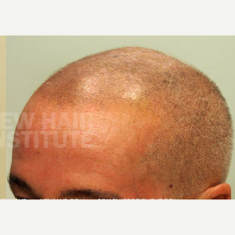65-74 year old man treated with Scalp Micropigmentation after 3093192