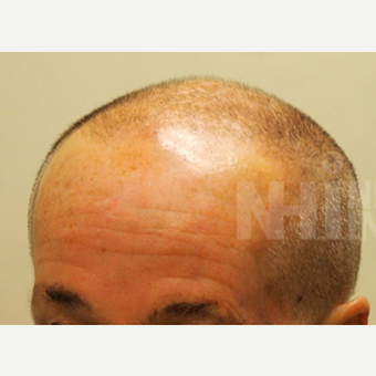 65-74 year old man treated with Scalp Micropigmentation before 3093192