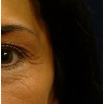 Chemical Brow Lift with Botox before 1559013