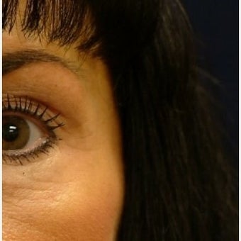 Chemical Brow Lift with Botox after 1559013