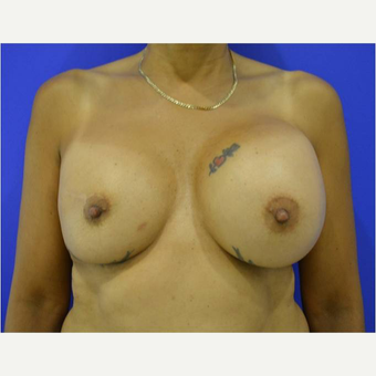45-54 year old woman treated with Breast Implant Revision before 3744624