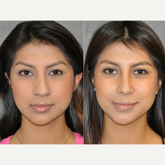 18-24 year old woman treated with Rhinoplasty before 3176112