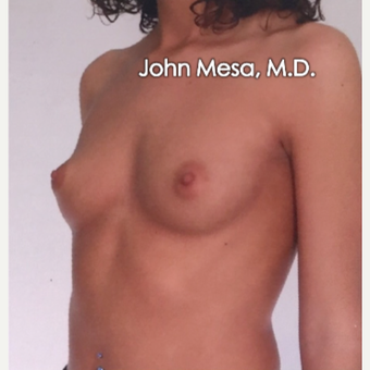 25-34 year old woman treated with Sientra Breast Implants before 3266836