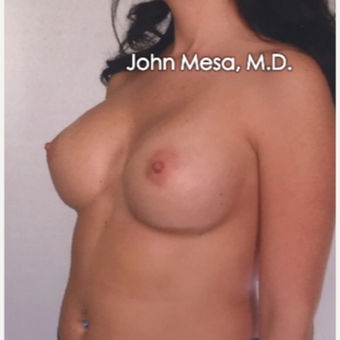 25-34 year old woman treated with Sientra Breast Implants after 3266836