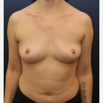 45-54 year old woman treated with Breast Augmentation before 3726764