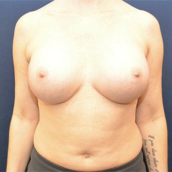 45-54 year old woman treated with Breast Augmentation after 3726764