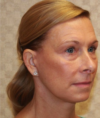 Patient wanted improvement in her neck and jowls and to soften the lines around her mouth and cheeks after 1170474
