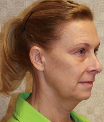 Patient wanted improvement in her neck and jowls and to soften the lines around her mouth and cheeks before 1170474