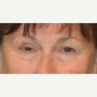 65-74 year old woman treated with Eyelid Surgery before 3487190