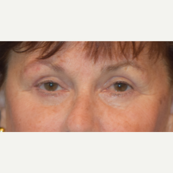 65-74 year old woman treated with Eyelid Surgery after 3487190