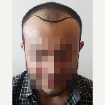 18-24 year old man treated with FUE Hair Transplant before 3729943