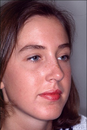 Rhinoplasty to correct multiple issues after 1023201