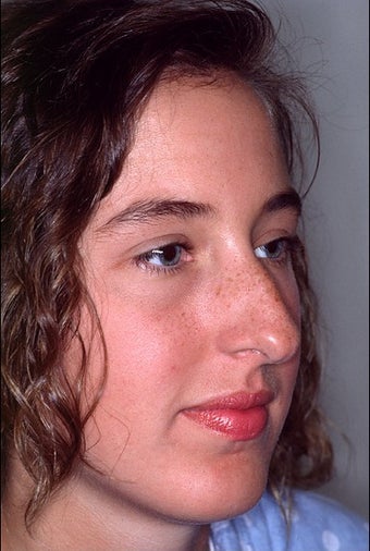 Rhinoplasty to correct multiple issues before 1023201