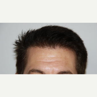35-44 year old man treated with FUE Hair Transplant after 3616873