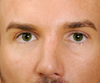 22 year old man who had rather unattractive eyes, showing 8 years following facial surgery. after 1373458