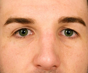 22 year old man who had rather unattractive eyes, showing 8 years following facial surgery. before 1373458