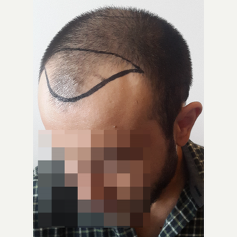 18-24 year old man treated with FUE Hair Transplant before 3729958